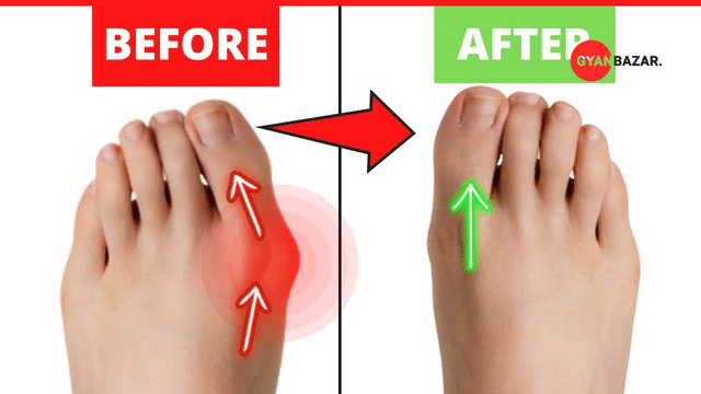 Bunions: Causes, Treatment, and Prevention