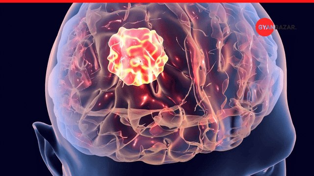 How brain tumors are diagnosed and treated